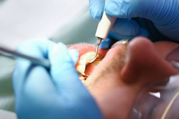 Best Dentist for Tooth Abscess  in Sanborn, NY